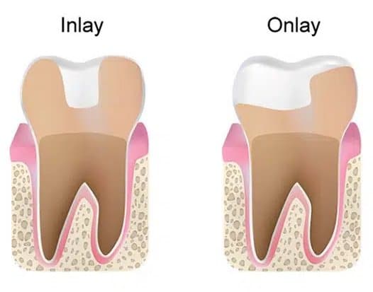 Inlays-Onlays Alhambra, CA