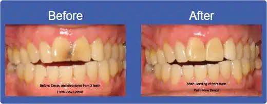 Dental Bonding Alhambra - Before After