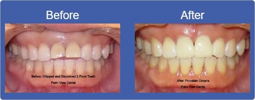 Dental Crowns Alhambra CA - Before & After