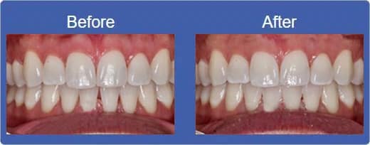 Dental Bonding Alhambra CA - Before & After
