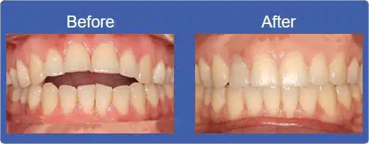 Invisalign Alhambra - Before & After