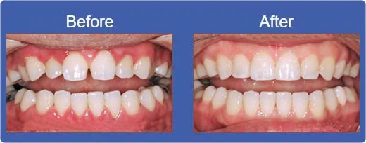 Invisalign Smile Alhambra CA - Before & After
