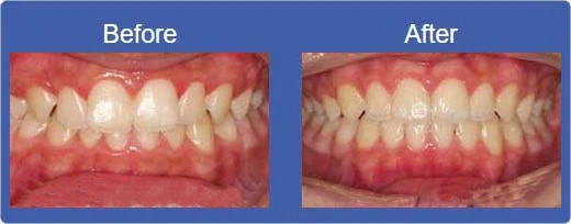 Invisalign Alhambra CA - Before & After