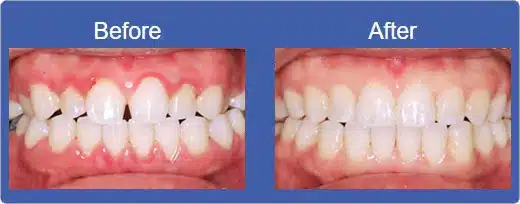 Invisalign Smile Alhambra CA - Before & After