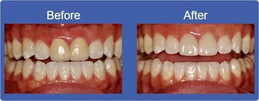 Pal View Dental Smile - Before & After